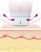 Angled tip design enables precise lifting for each facial area
