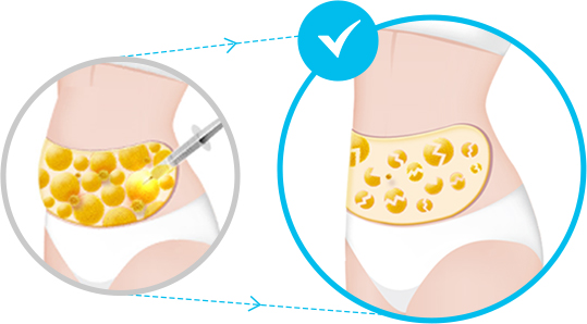 展示ID V邏輯身體PT注射破壞脂肪細胞過程的畫面