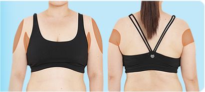 通過V邏輯身體PT注射手臂變細的圖片