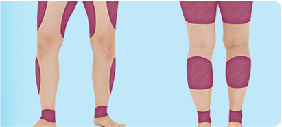 通過V邏輯身體PT注射腿部變細的圖片