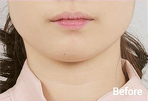 輪廓肉毒4種施術後V臉效果照片
