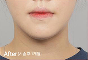 輪廓肉毒4種施術後V臉效果照片