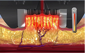 顯示InMode FX模式對皮膚層影響的圖片