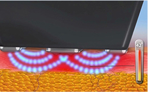 顯示InMode FORMA模式對皮膚層影響的圖片