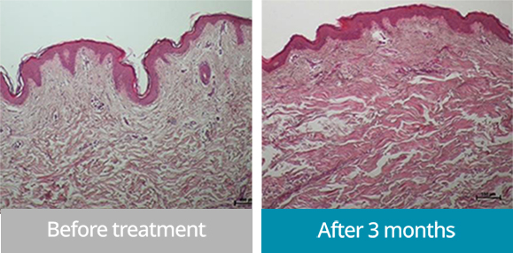 ONDA提升治療前後對比照片 - 促進膠原蛋白生成的提拉和彈性改善效果