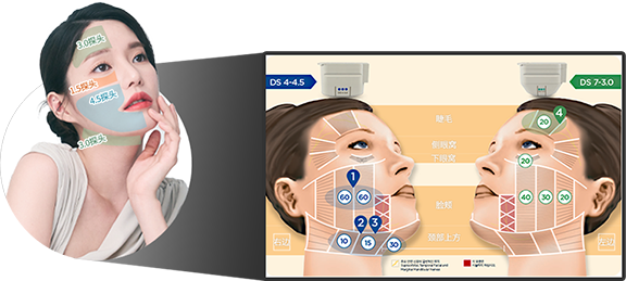 介紹適用於眉毛 側眶 下眶 臉頰 上頸等不同臉型的Ulthera美版超聲刀探頭種類