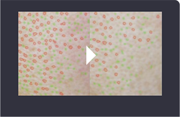 Rejuran麗珠蘭治療4週後毛孔縮小對比圖片