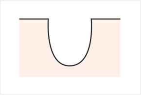 毛孔和疤痕的不同形狀-冰錐形 圓盤形 盒子形