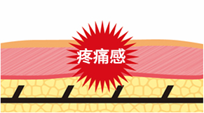 說明普通線雕術後線上的倒鉤如何刺激神經導致疼痛